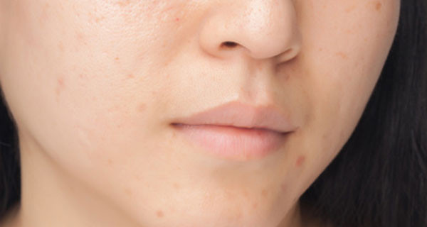 Come combattere l’acne nei giovani? Consigli degli esperti Come combattere l’acne nei giovani? Consigli degli esperti