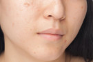 Come combattere l’acne nei giovani? Consigli degli esperti